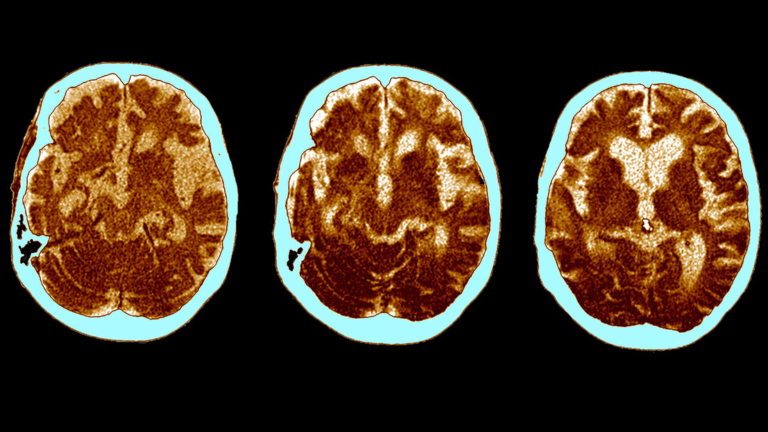 El cerebro de los supervivientes de una forma grave de covid-19 envejece 20 años, dice un nuevo estudio