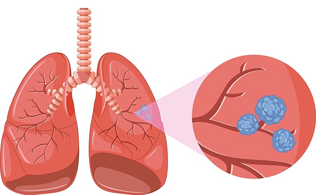 El cáncer de pulmón tiene un diagnóstico tardío en 85% de los casos 