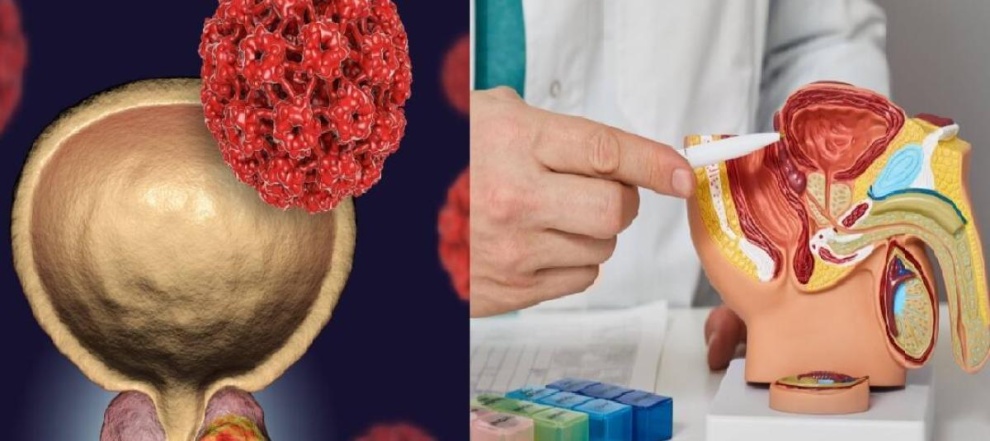 Hoy se conmemora el Día Mundial del Cáncer de Próstata